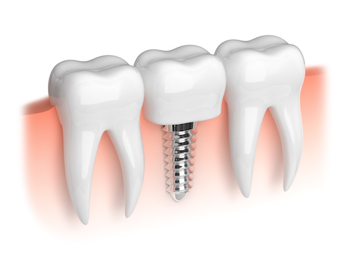 Dental Implants by Dr. Vazira